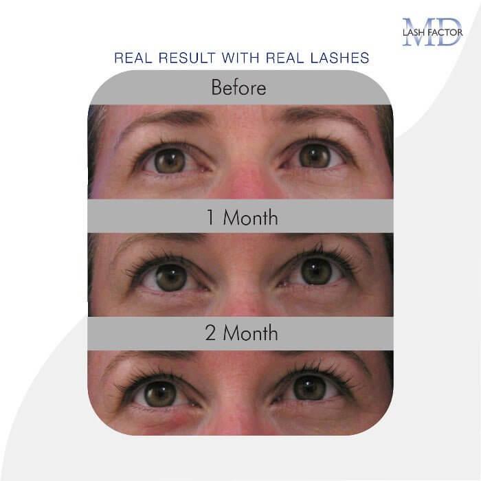 Before, 1-month, and 2-month lash growth results woman showing visibly longer lashes using MD Lash Factor 3-Month Supply